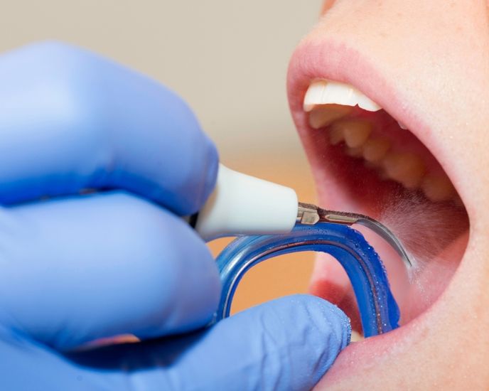 Limpieza dental profesional y profunda