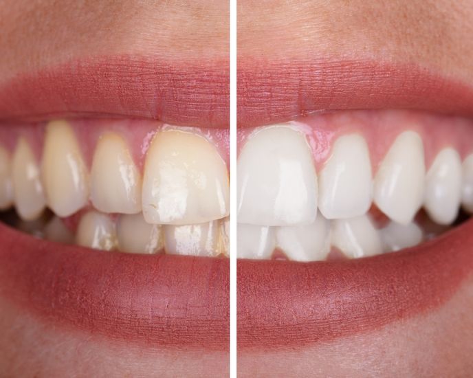 Blanqueamiento dental profesional